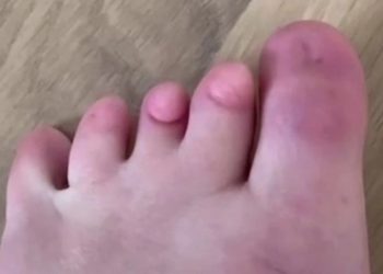 Langka! Perempuan Ini Pamer Tak Punya Kuku Kaki