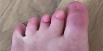 Langka! Perempuan Ini Pamer Tak Punya Kuku Kaki