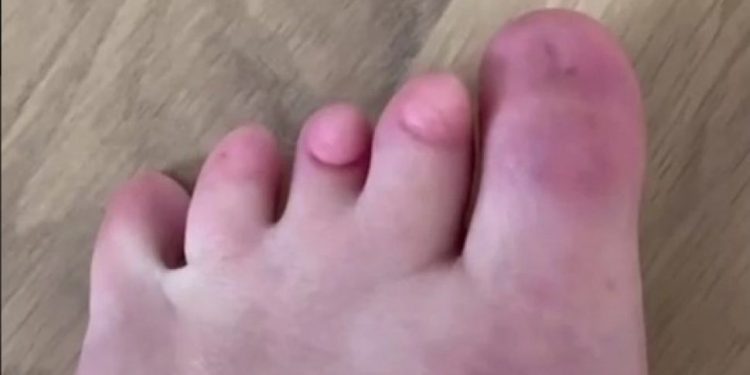Langka! Perempuan Ini Pamer Tak Punya Kuku Kaki