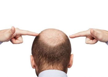 Rambut Botak Bikin Enggak Pede, Begini Cara Mengatasinya