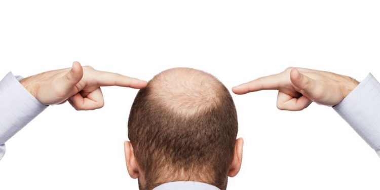 Rambut Botak Bikin Enggak Pede, Begini Cara Mengatasinya